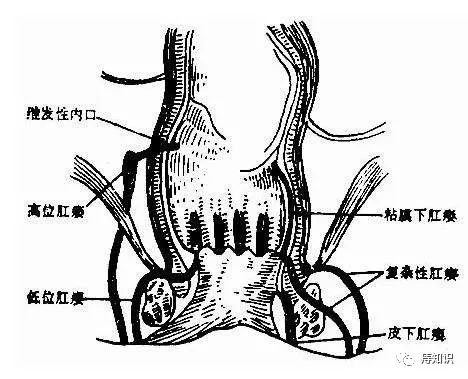 肛瘘如何治疗