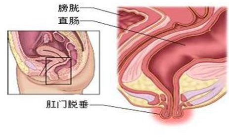 哪些人容易脱肛？