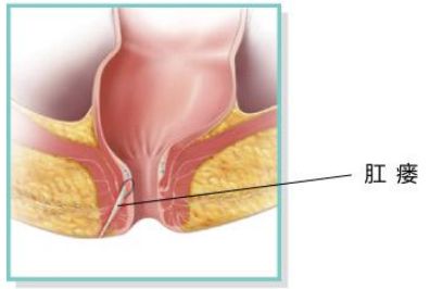 肛瘘是肛门漏了吗
