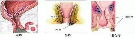 患上痔疮会给身体带来哪些危害？