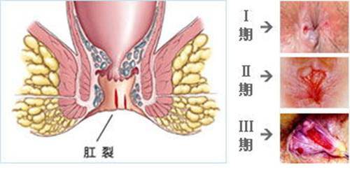 冬季如何有效预防肛裂？