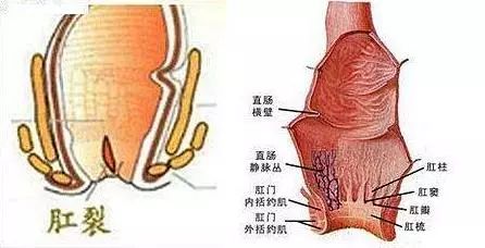 便血未必是痔疮