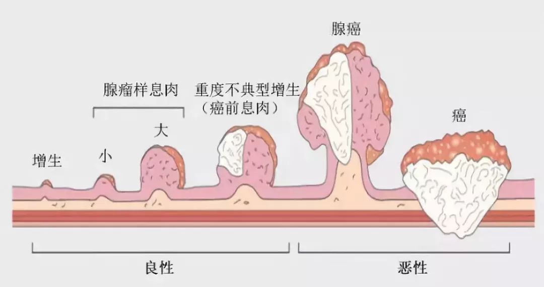 有肛门息肉怎么办