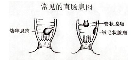 直肠息肉危害有哪些