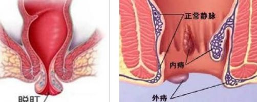 肛门有脱出物是痔疮吗?