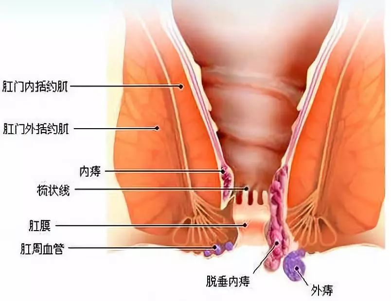 混合痔反复发作怎么办