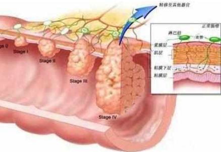 大肠息肉是什么