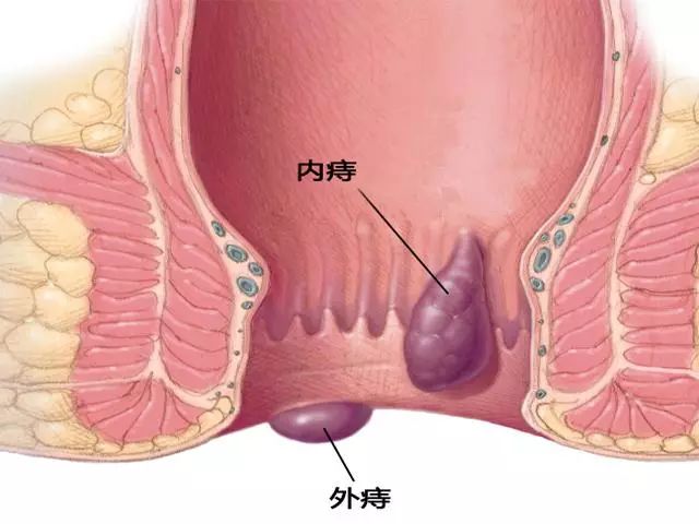 怎么判断自己患了哪种肛肠疾病