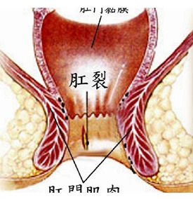 肛裂了怎么办