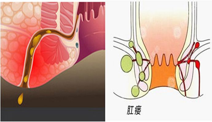 肛瘘必须要手术治疗吗