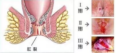 有肛裂被怀疑男男？